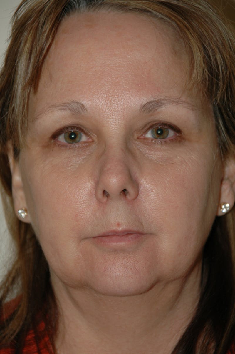 Facelift Before & After Gallery - Patient 53599863 - Image 1
