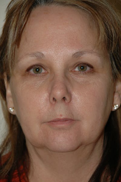 Facelift Before & After Gallery - Patient 53599863 - Image 1