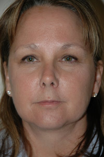 Facelift Before & After Gallery - Patient 53599863 - Image 2