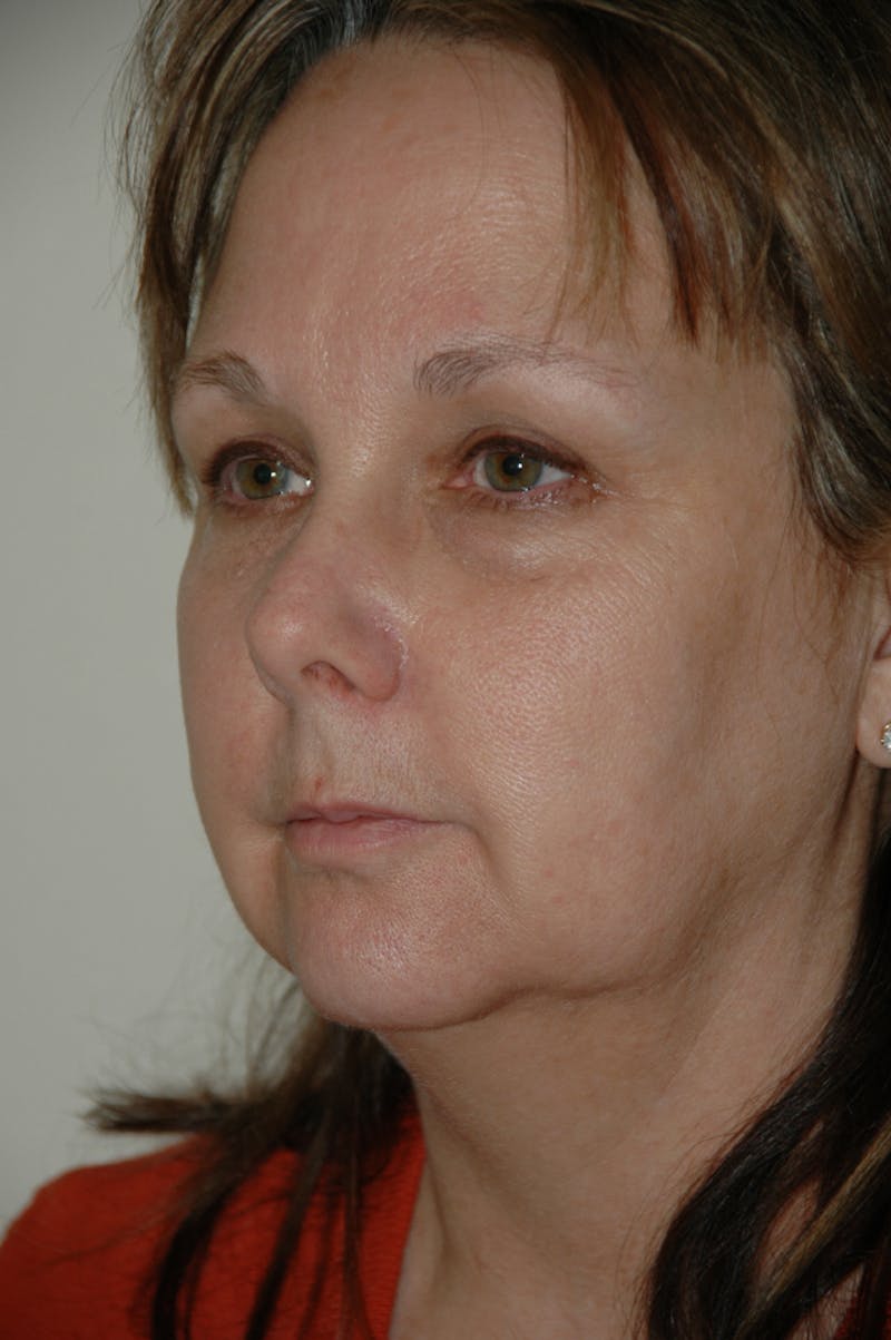 Facelift Before & After Gallery - Patient 53599863 - Image 3