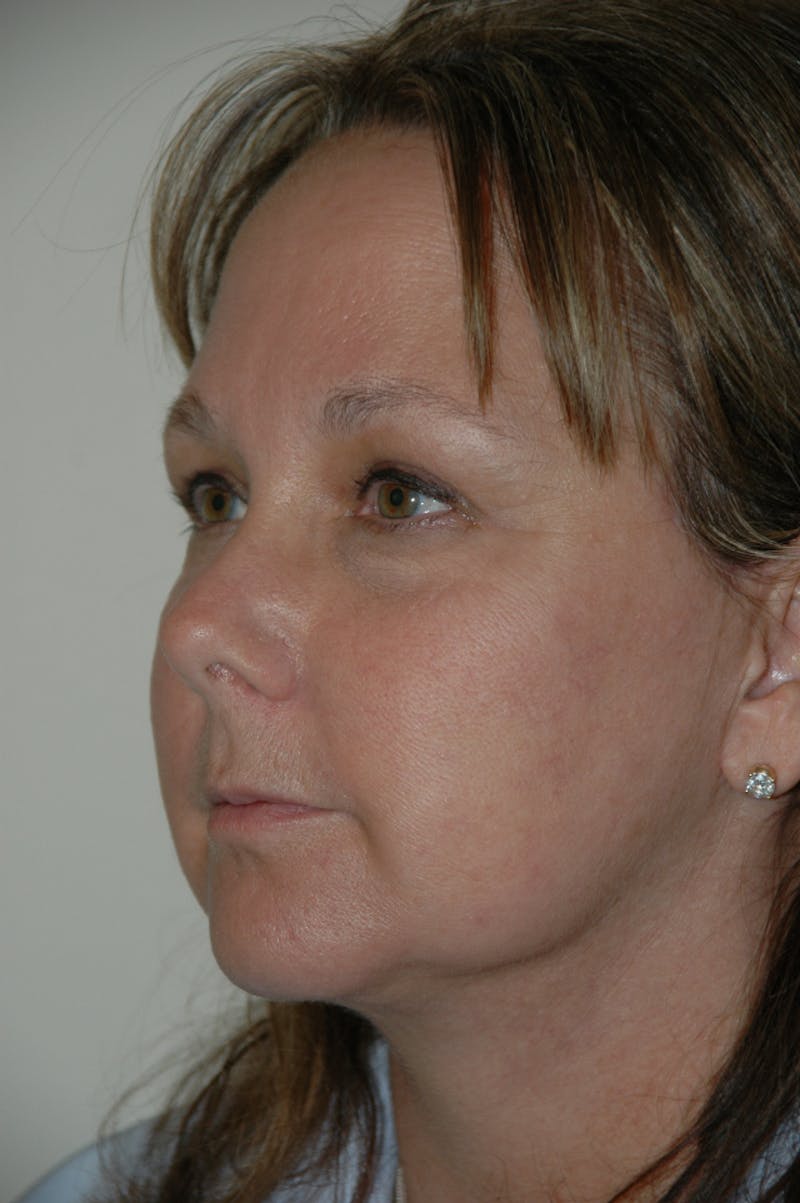 Facelift Before & After Gallery - Patient 53599863 - Image 4