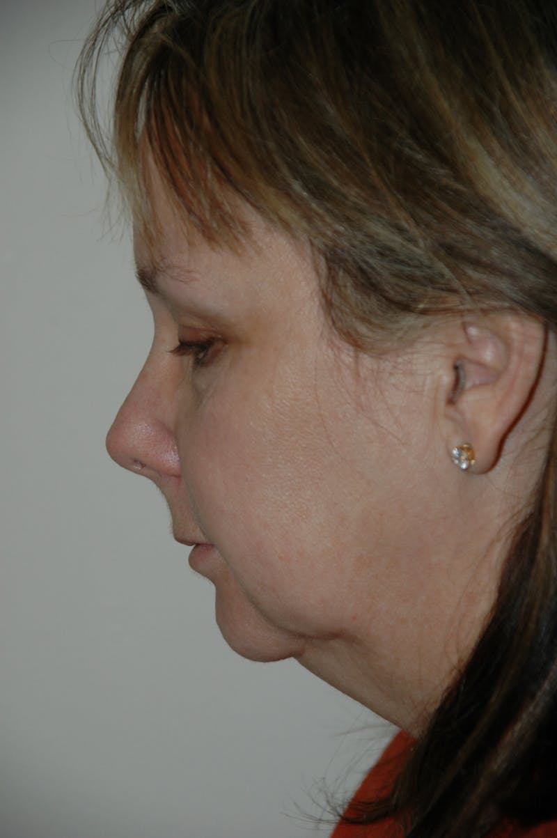 Facelift Before & After Gallery - Patient 53599863 - Image 5