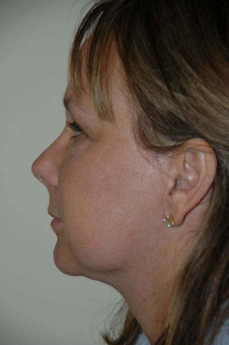 Facelift Before & After Gallery - Patient 53599863 - Image 6
