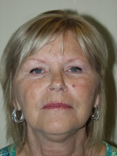 Facelift Before & After Gallery - Patient 53599865 - Image 1