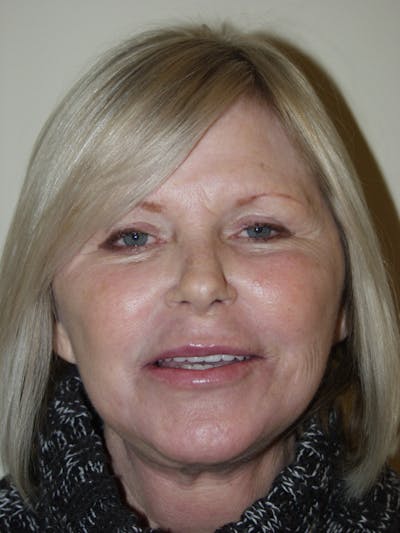 Facelift Before & After Gallery - Patient 53599865 - Image 2
