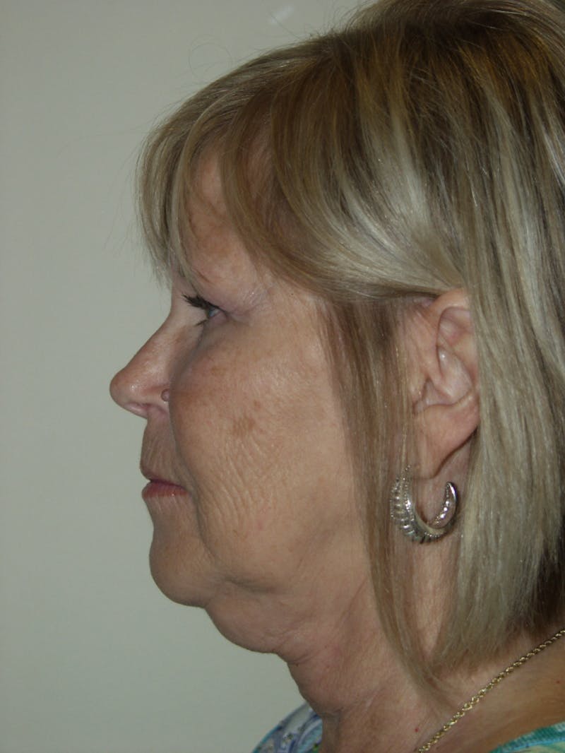Facelift Before & After Gallery - Patient 53599865 - Image 3
