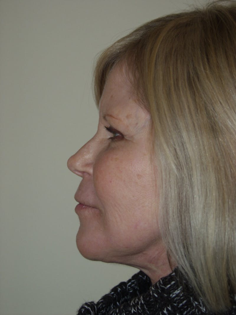 Facelift Before & After Gallery - Patient 53599865 - Image 4
