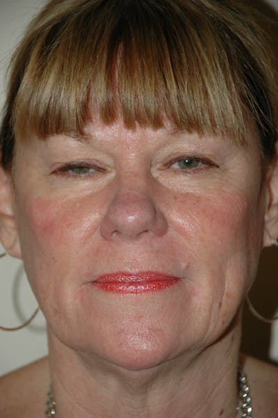 Facelift Before & After Gallery - Patient 53599880 - Image 1