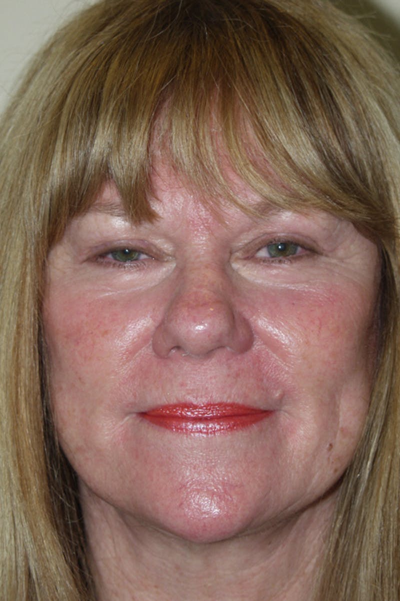 Facelift Before & After Gallery - Patient 53599880 - Image 2
