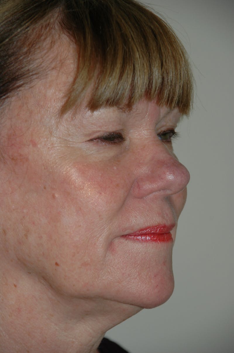 Facelift Before & After Gallery - Patient 53599880 - Image 3