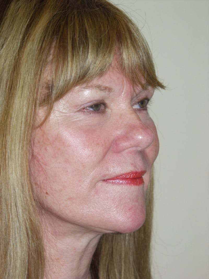 Facelift Before & After Gallery - Patient 53599880 - Image 4