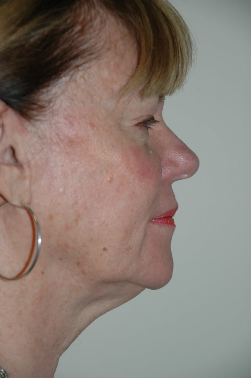 Facelift Before & After Gallery - Patient 53599880 - Image 5