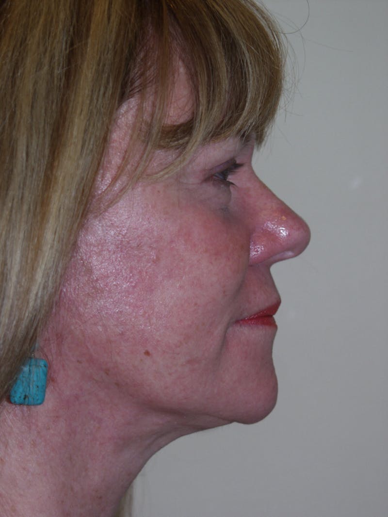 Facelift Before & After Gallery - Patient 53599880 - Image 6