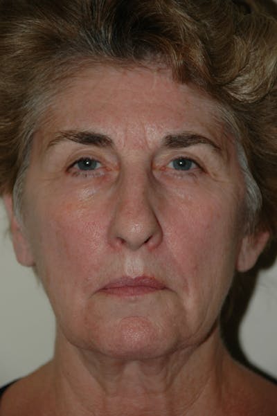Facelift Before & After Gallery - Patient 53599882 - Image 1
