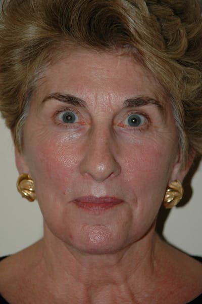 Facelift Before & After Gallery - Patient 53599882 - Image 2