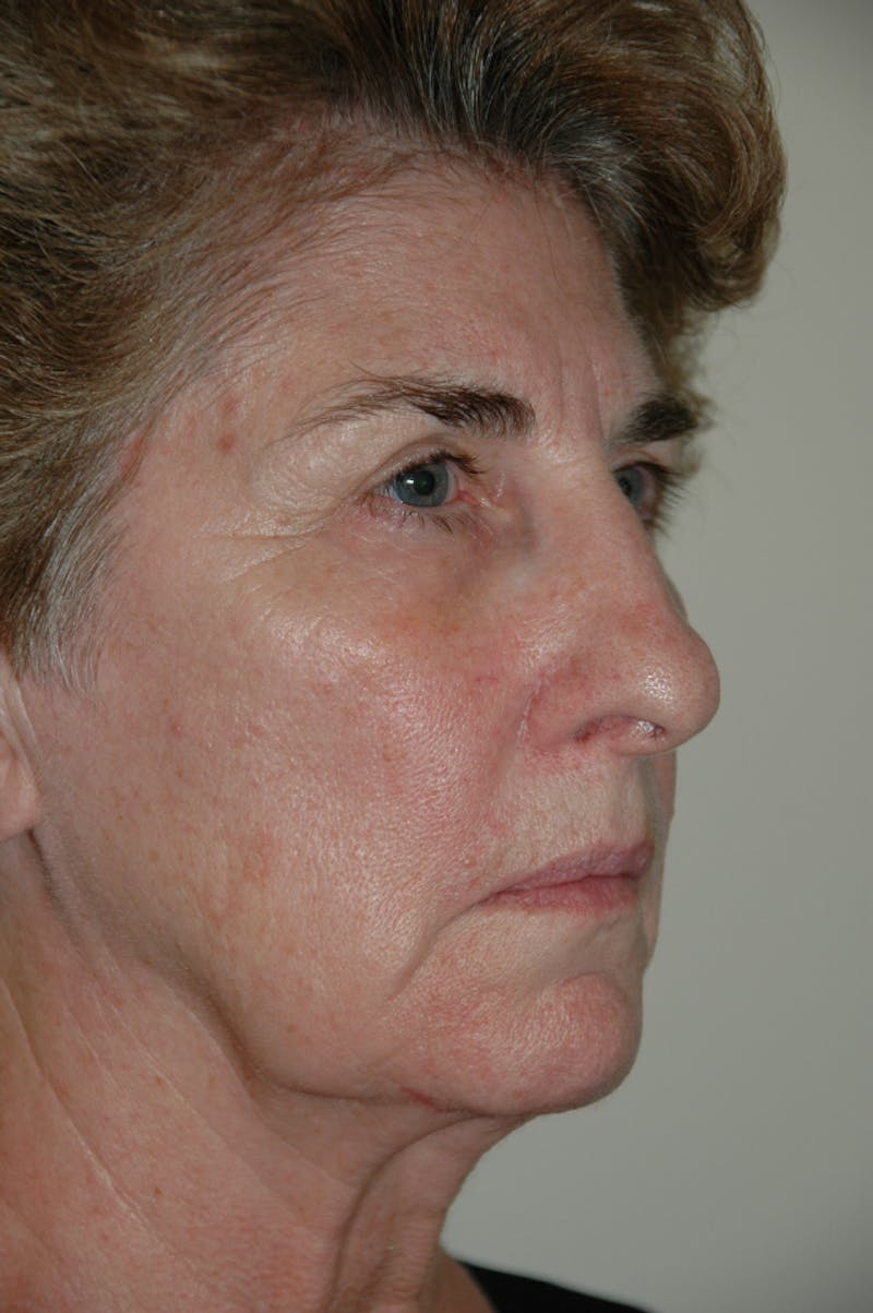 Facelift Before & After Gallery - Patient 53599882 - Image 3