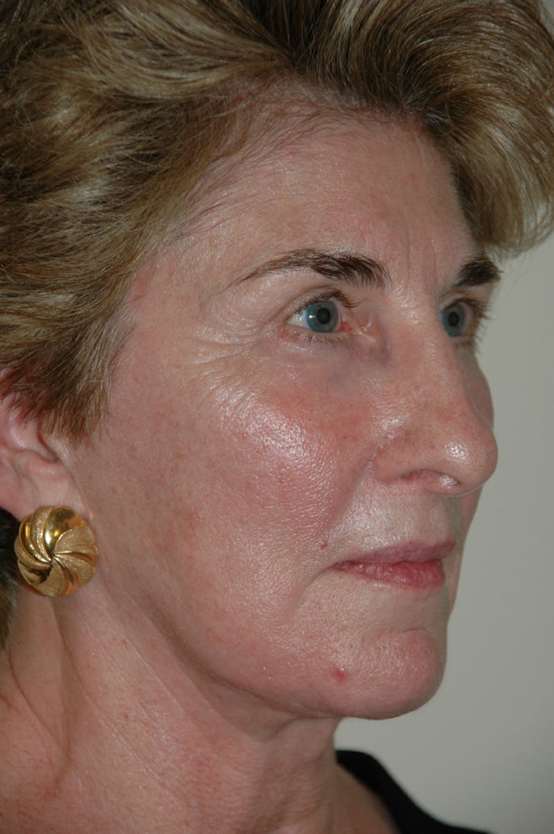 Facelift Before & After Gallery - Patient 53599882 - Image 4