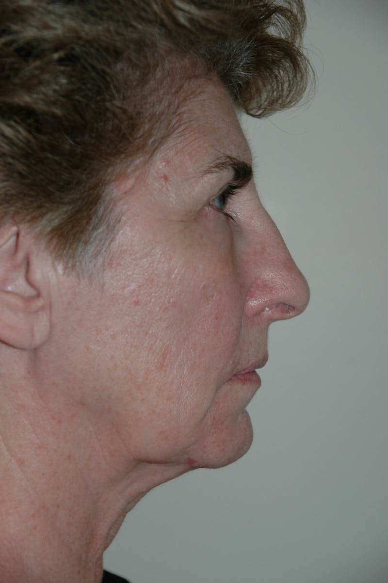Facelift Before & After Gallery - Patient 53599882 - Image 5