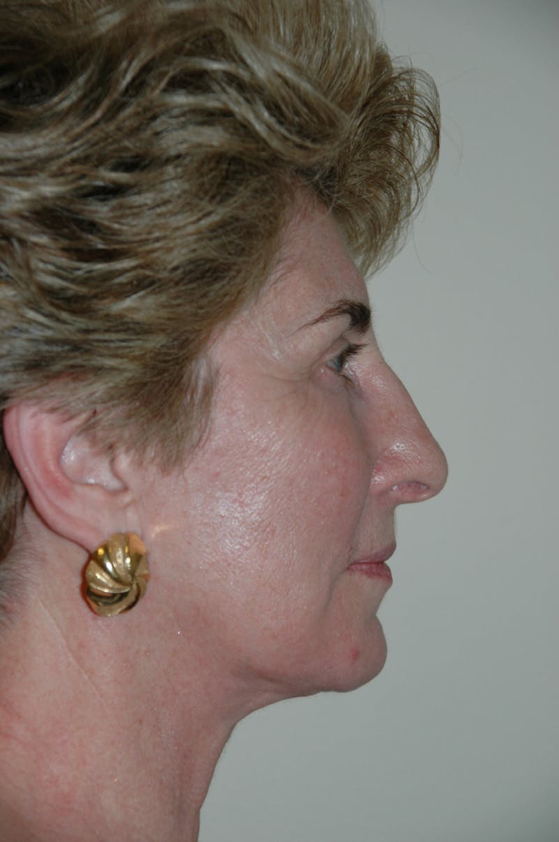 Facelift Before & After Gallery - Patient 53599882 - Image 6