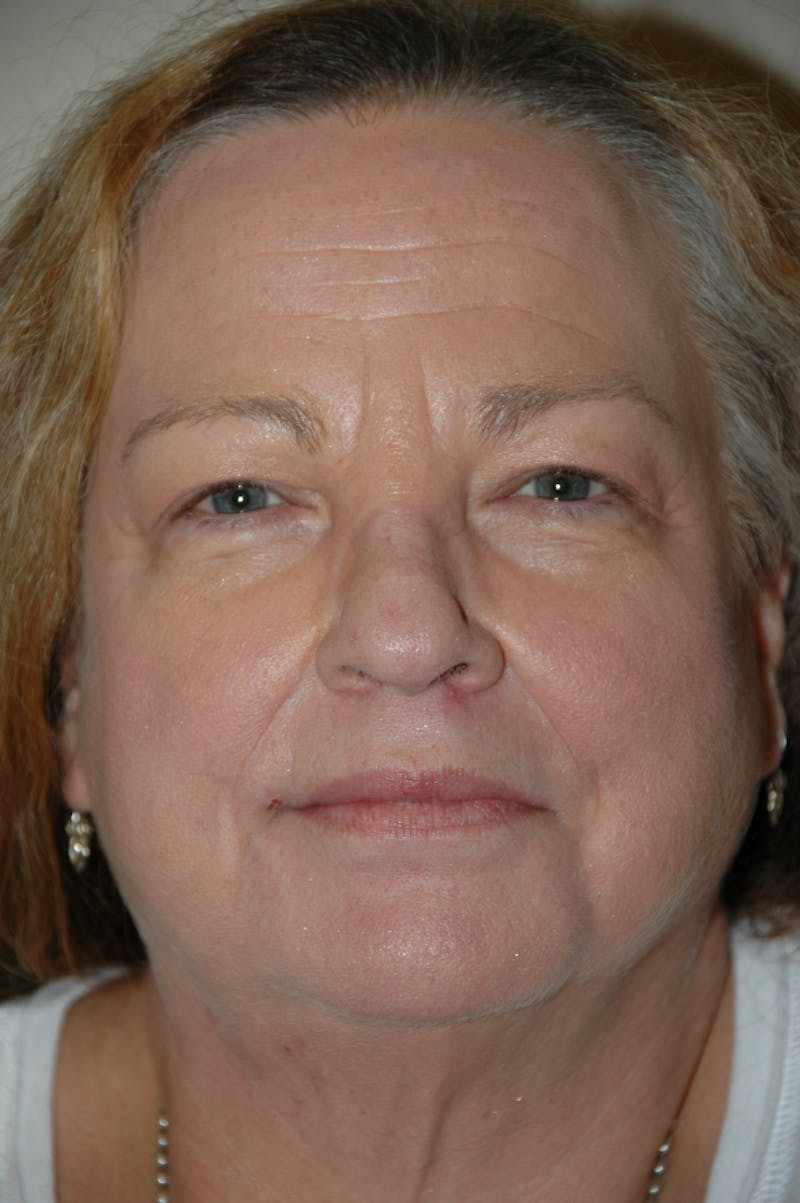 Facelift Before & After Gallery - Patient 53599883 - Image 1