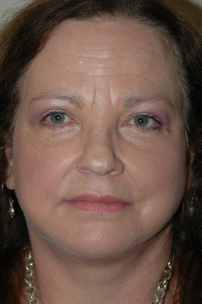 Facelift Before & After Gallery - Patient 53599883 - Image 2