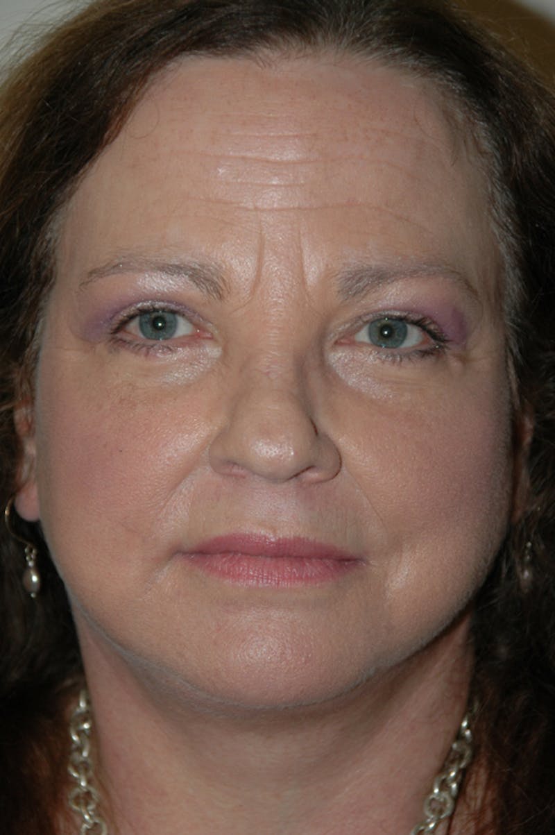 Facelift Before & After Gallery - Patient 53599883 - Image 2