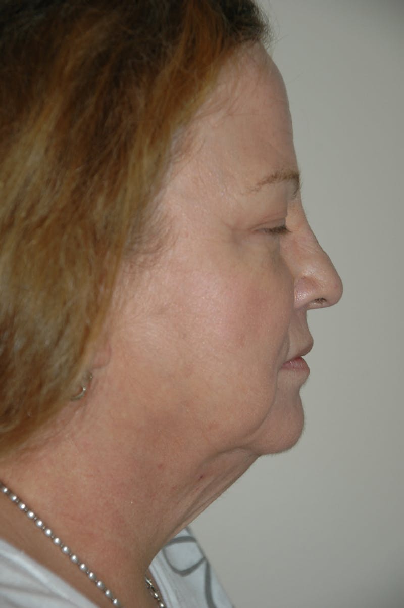 Facelift Before & After Gallery - Patient 53599883 - Image 3