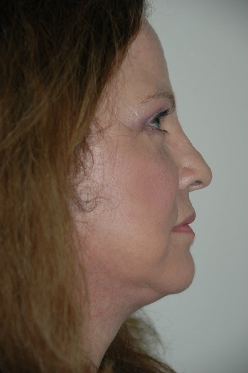 Facelift Before & After Gallery - Patient 53599883 - Image 4