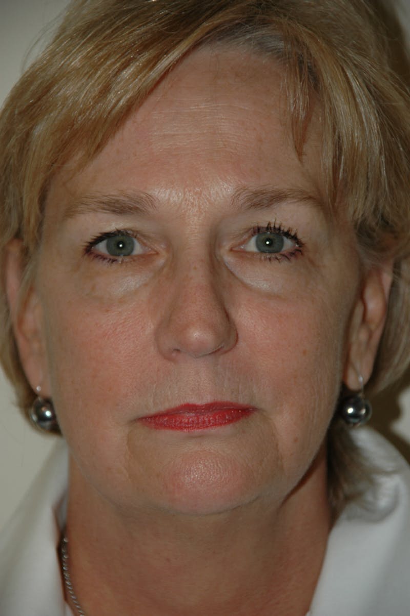 Facelift Before & After Gallery - Patient 53599885 - Image 1