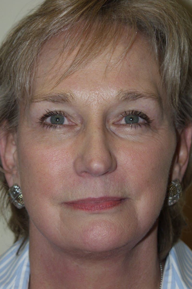 Facelift Before & After Gallery - Patient 53599885 - Image 2
