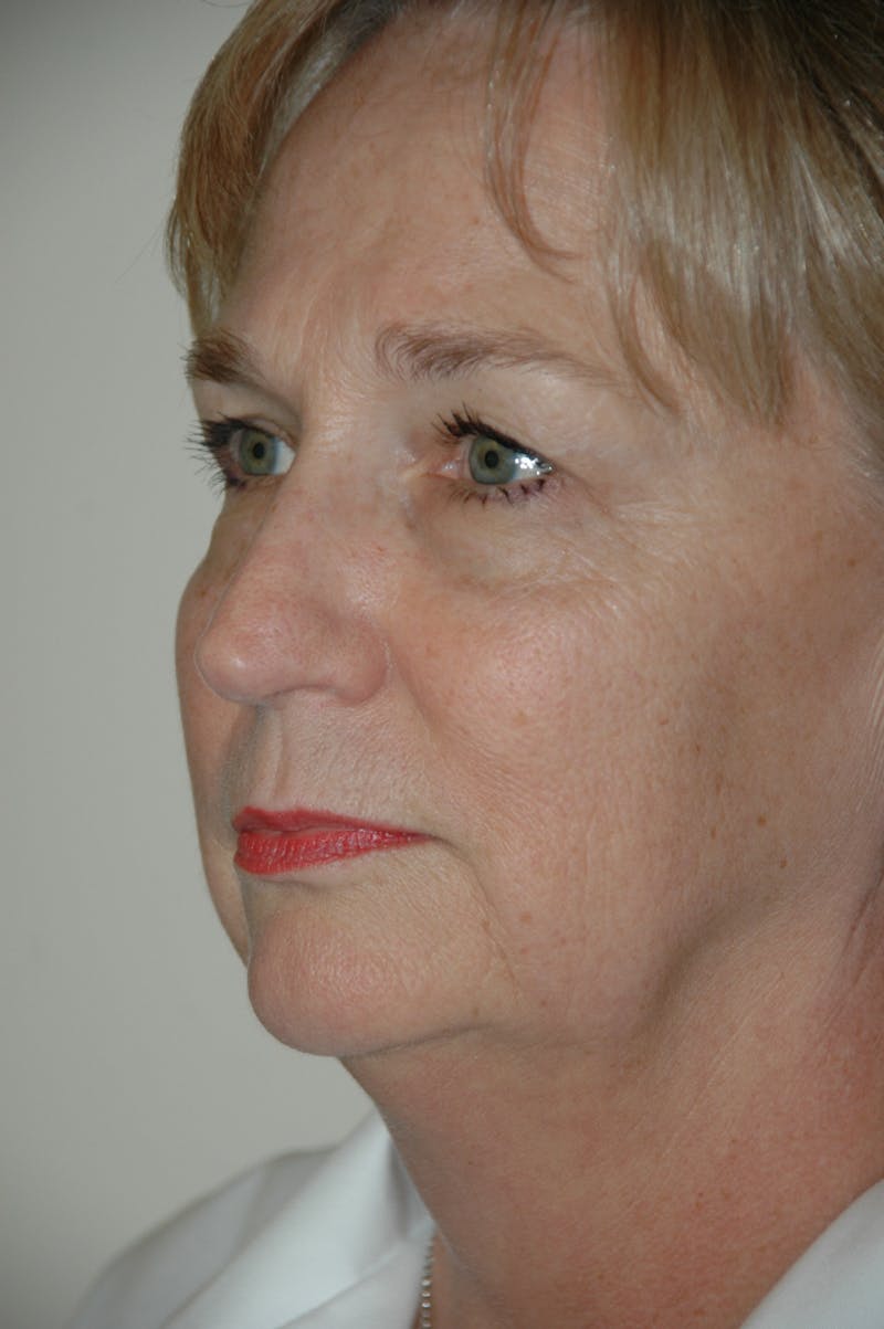 Facelift Before & After Gallery - Patient 53599885 - Image 3