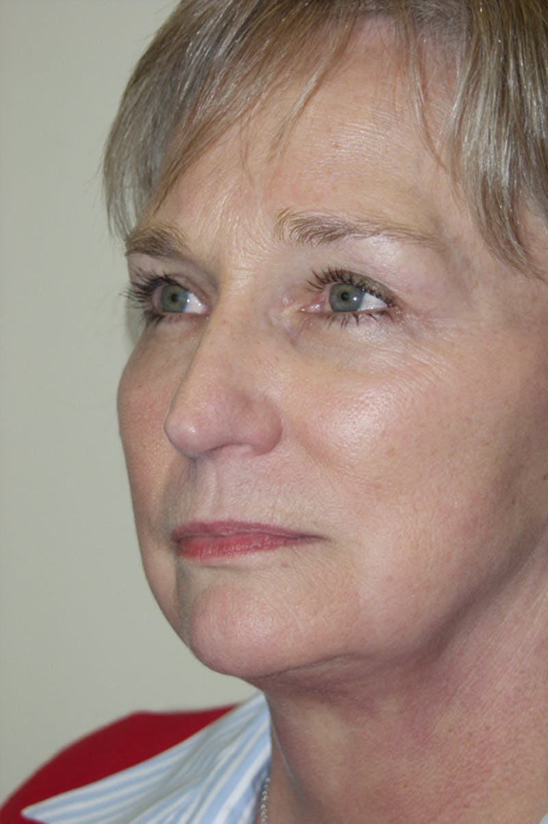 Facelift Before & After Gallery - Patient 53599885 - Image 4