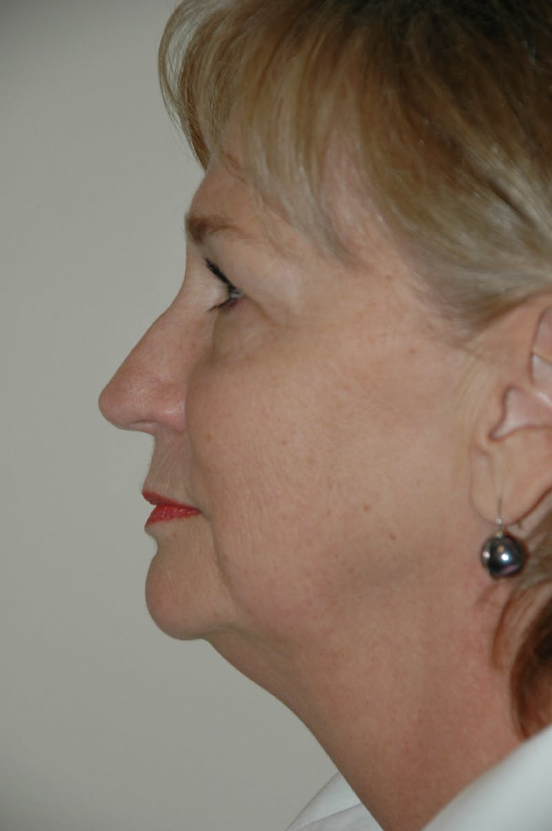 Facelift Before & After Gallery - Patient 53599885 - Image 5