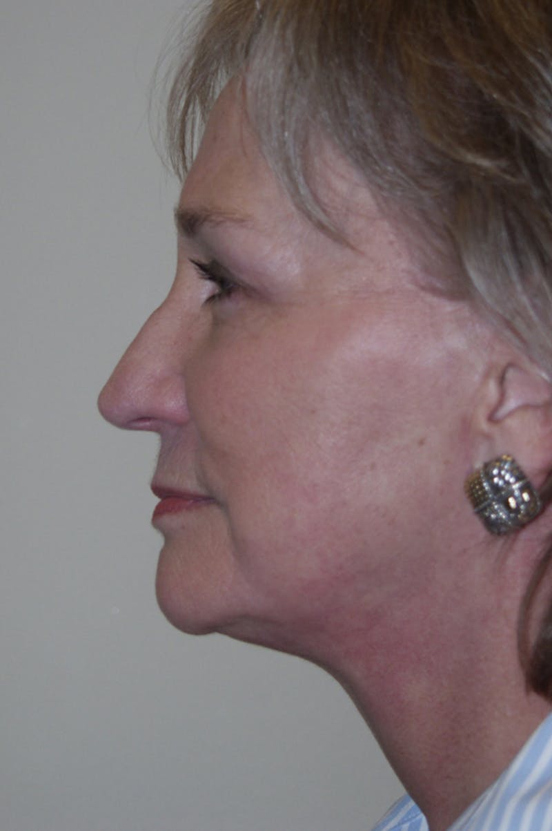 Facelift Before & After Gallery - Patient 53599885 - Image 6