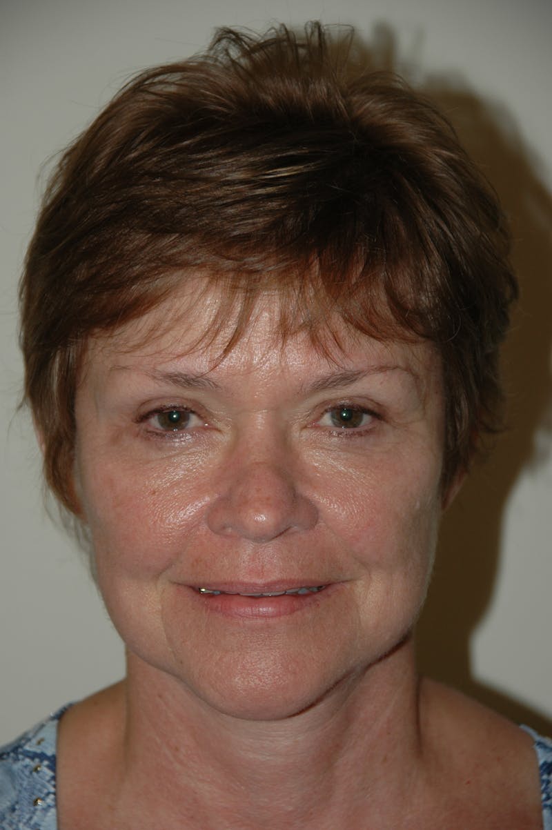 Facelift Before & After Gallery - Patient 53599891 - Image 2