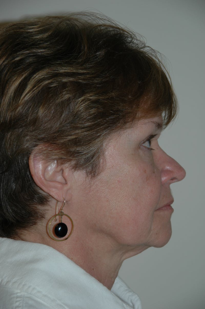 Facelift Before & After Gallery - Patient 53599891 - Image 3