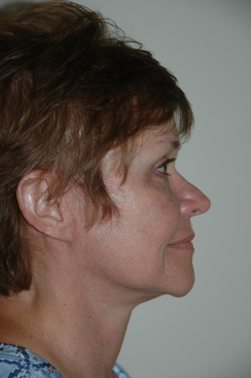Facelift Before & After Gallery - Patient 53599891 - Image 4