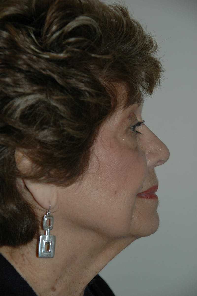 Facelift Before & After Gallery - Patient 53599906 - Image 3