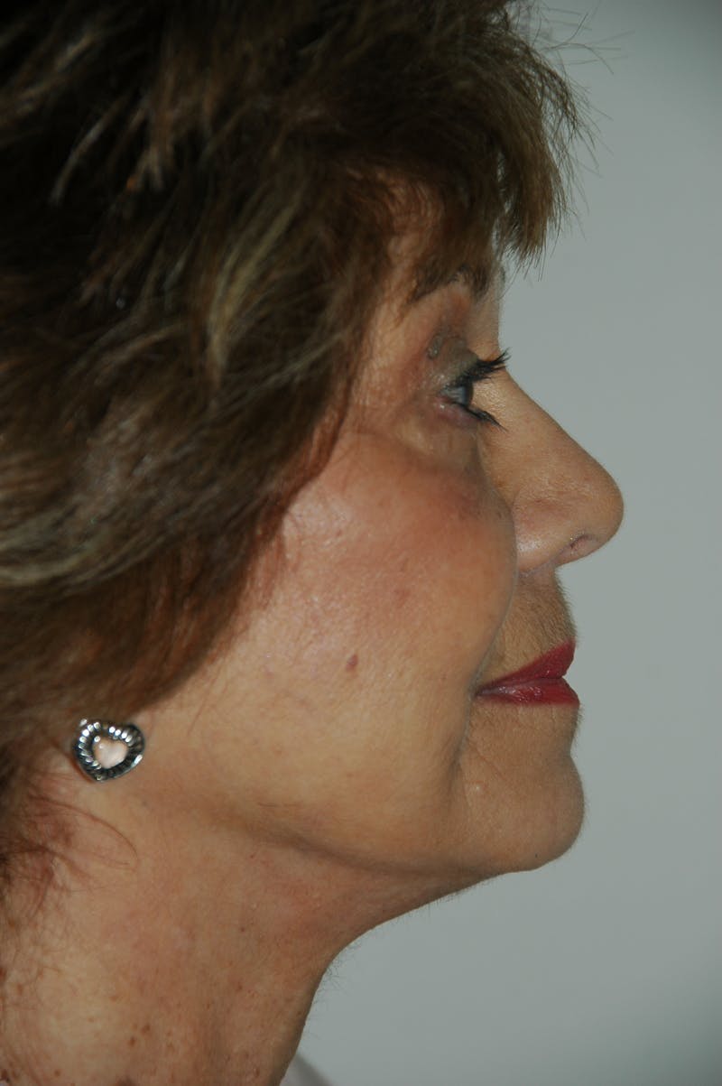 Facelift Before & After Gallery - Patient 53599906 - Image 4