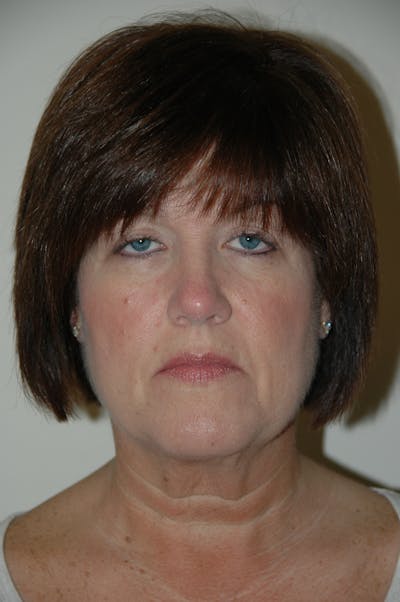 Facelift Before & After Gallery - Patient 53599907 - Image 1