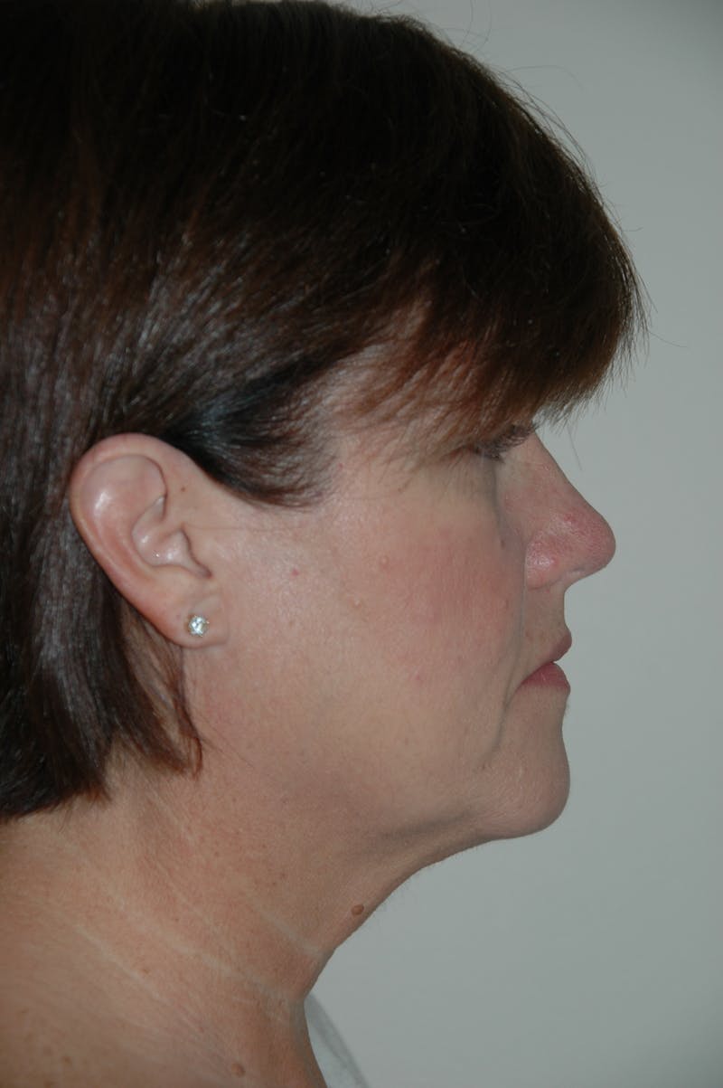 Facelift Before & After Gallery - Patient 53599907 - Image 3