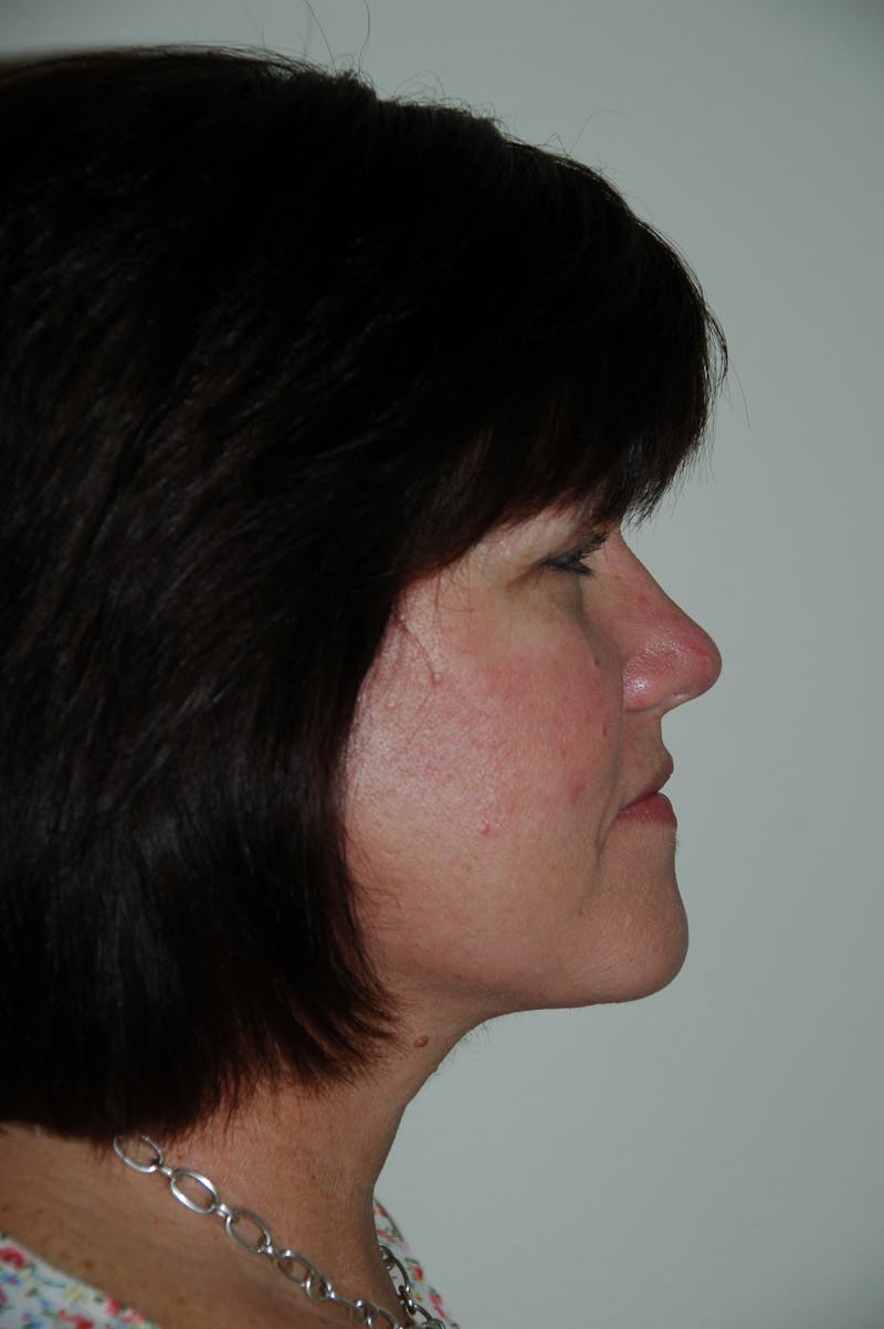 Facelift Before & After Gallery - Patient 53599907 - Image 4
