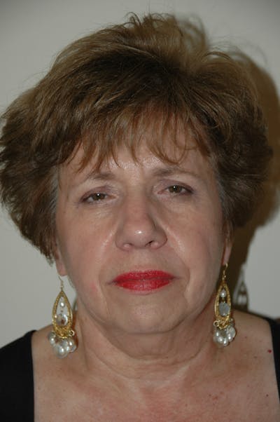 Facelift Before & After Gallery - Patient 53599908 - Image 1