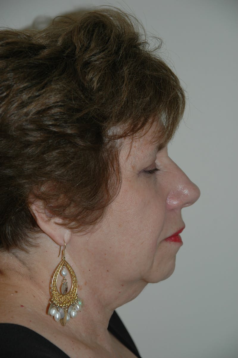Facelift Before & After Gallery - Patient 53599908 - Image 3