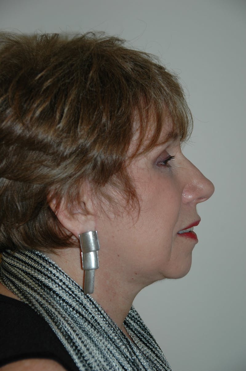 Facelift Before & After Gallery - Patient 53599908 - Image 4