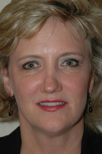 Facelift Before & After Gallery - Patient 53599909 - Image 1