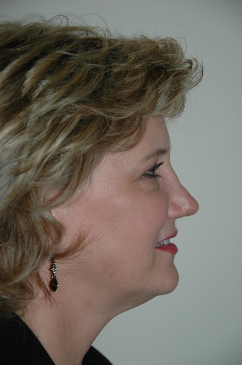 Facelift Before & After Gallery - Patient 53599909 - Image 3