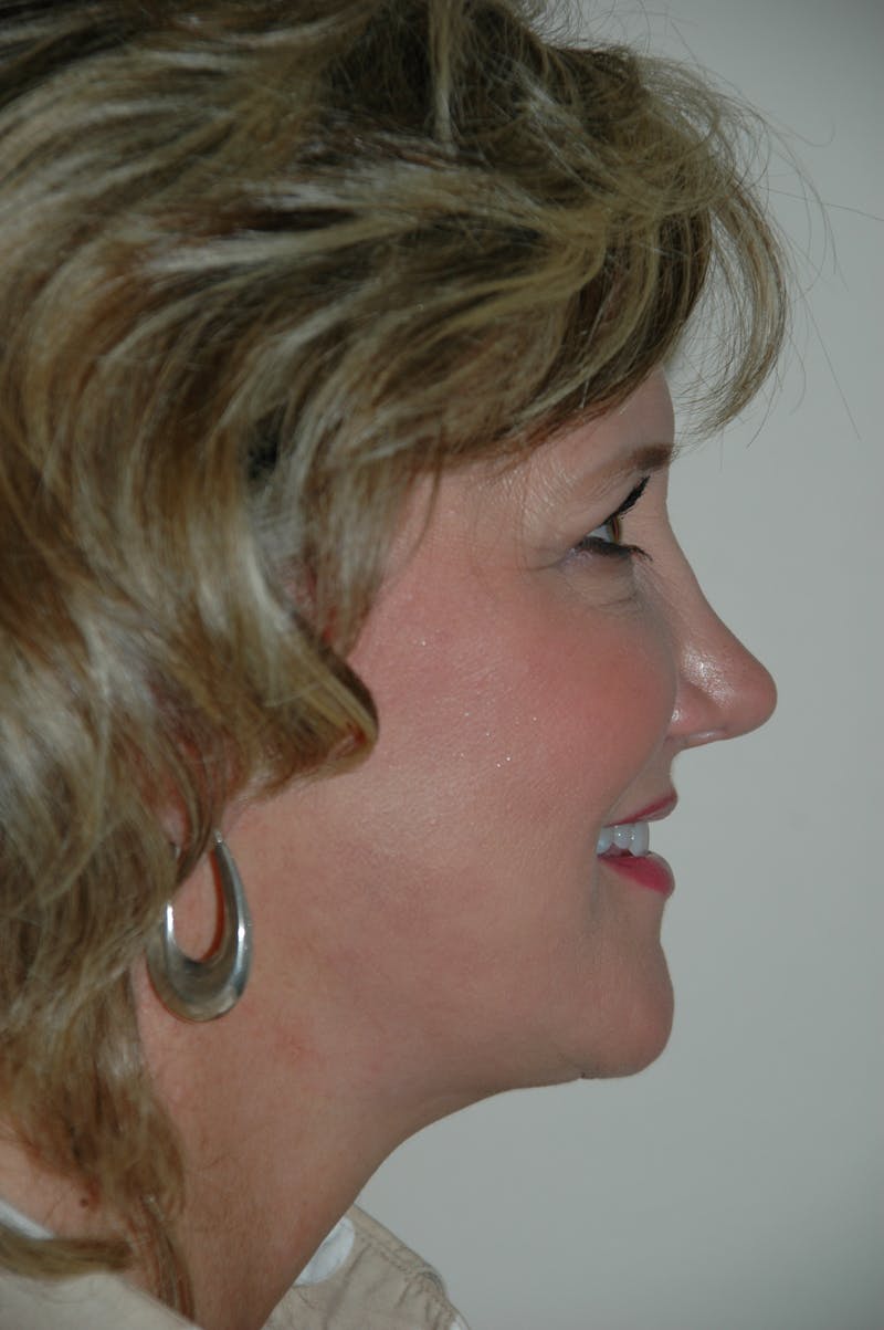 Facelift Before & After Gallery - Patient 53599909 - Image 4
