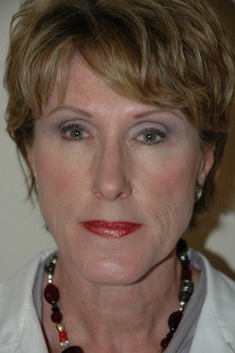 Facelift Before & After Gallery - Patient 53599912 - Image 1