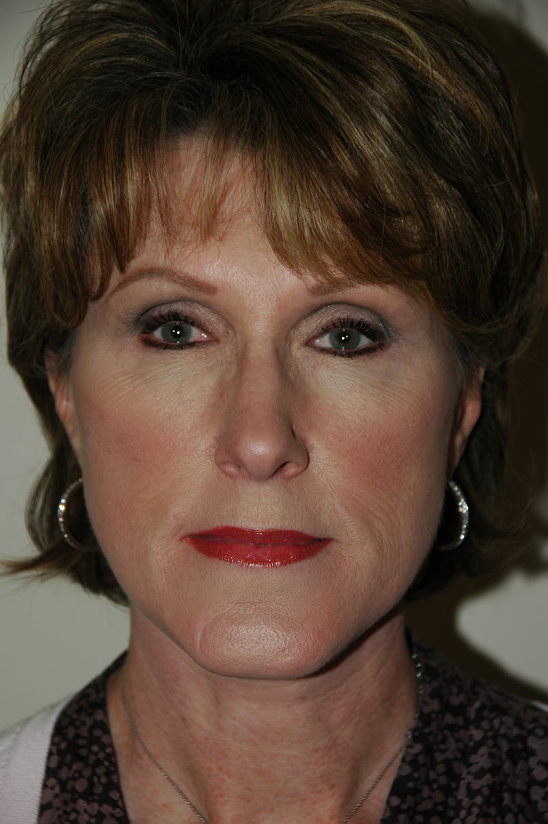 Facelift Before & After Gallery - Patient 53599912 - Image 2